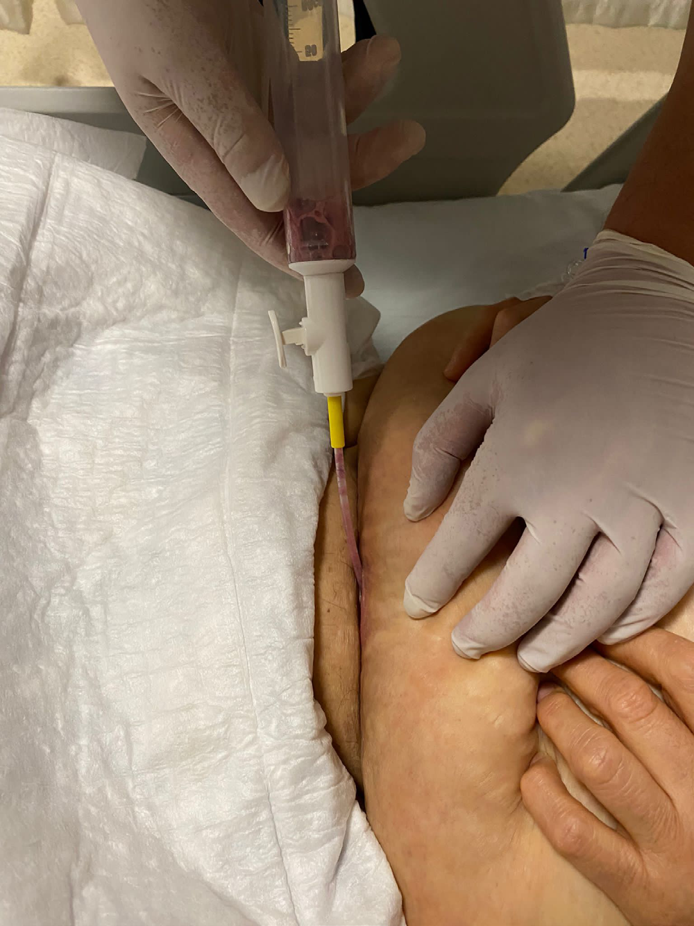 Figure 1: Treating Wound Infection with Karman Cannula.