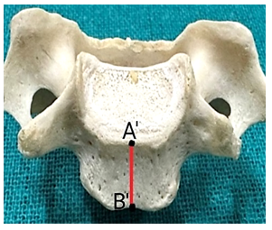 Figure 2: Showing the Anterior height of the vertebral body of the Typical Cervical Vertebrae.