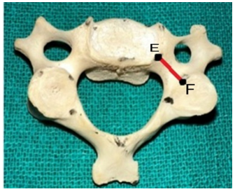 Figure 5: Showing the length of the pedicle of the Typical Cervical Vertebrae.