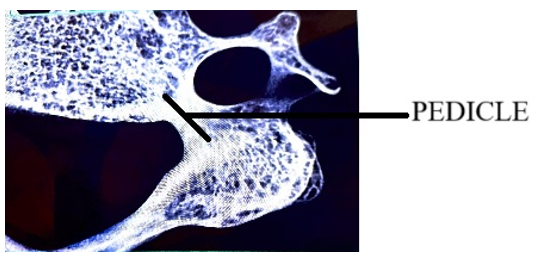Figure 6: Showing the radiological image of the pedicle of the Typical Cervical Vertebrae.