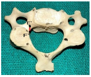 Figure 7: Showing the Height of the pedicle.