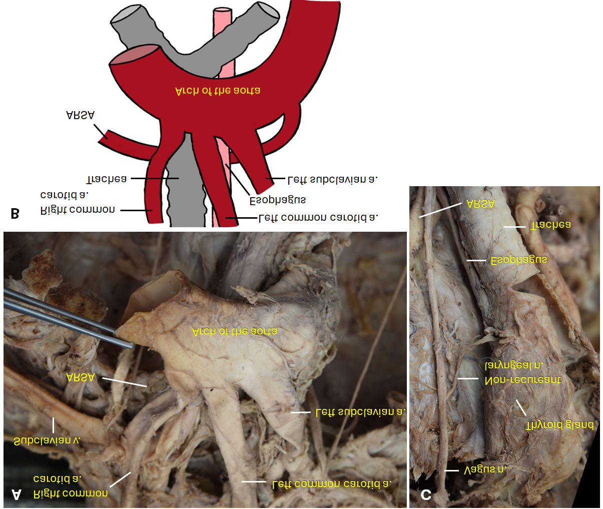 Figure 2: Aberrant right subclavian a. (ARSA) extending retro-esophageal. (A) Photograph of donor 2 with ARSA. (B) Sketch of ARSA based on observation of donors 1 and 2. (C) Photograph of donor 1 with a non-recurrent laryngeal n. (NRLN) and ARSA.