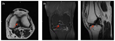Figure 3: MRI of the left knee. Axial T2 non-fat saturation (3a), coronal proton density fat saturation (3b), sagittal T2 non-fat saturation (3c) demonstrate the intact fibers of anterior cruciate ligament.