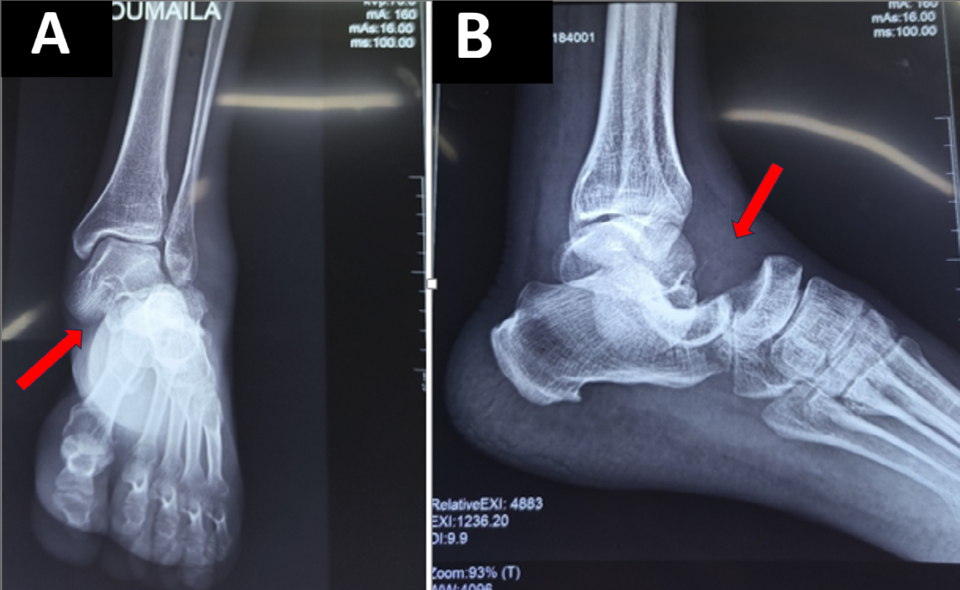 Figure 2: Standard radiographs of the left ankle, front (A) and side (B), showing the external subtalar dislocation (red arrows).