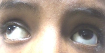 Figure 2: EOM=Full in all gaze in both eyes.