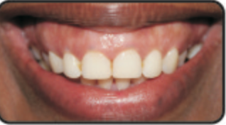 Figure 1: Preoperative view showing about 8 mm of gingival display.