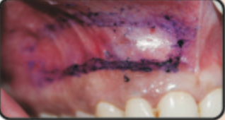 Figure 2: Incisions demarcated with a sterile pencil.
