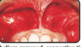 Figure 5: Continuous interlocking sutures done.