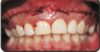 Figure 6: 2 weeks post operative at suture removal shows minimal scarring.