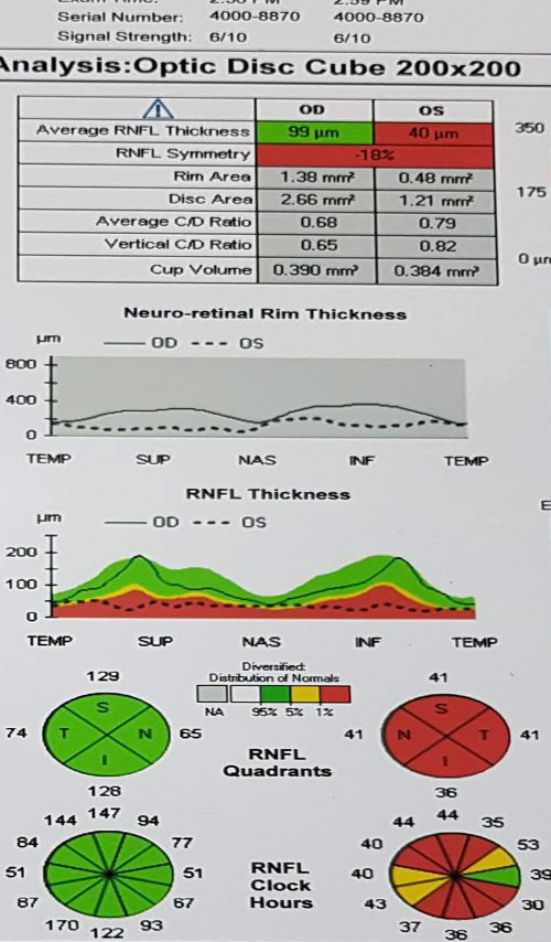 Figure 2: Generalized RNFL thinning (left eye).