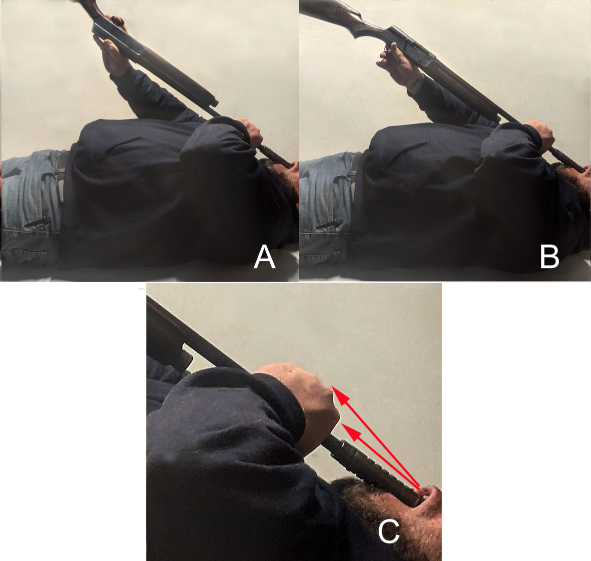 Figure 19: Cobain suicide scenario simulations of the shotgun positions; the simulation shotgun had the same dimensions as the Cobain shotgun (Figure 4C). The compensator muzzle in these simulations was not in contact with the hard palate due to the volunteer’s difficulty in attaining that position. The trigger could be reached in both suicide scenarios with the shotgun trigger either up or down even when the compensator muzzle was not in contact with the hard palate. The left hand, which was gripping the shotgun barrel when Cobain was found, should have had blood spatter if that was the position it was in when the shotgun discharged. It did not (Figure 8A). Images from author MG. A. The shotgun ventral side up (trigger up) simulates the suicide shotgun position prior to discharge at the death scene. B. The dorsal side up (trigger down) position of the shotgun in the suicide scenario; this was not the shotgun position when the body was found but was the position where the backspatter occurred. C. Close-up of the simulation suicide victim; arrows indicate the backspatter projection onto the lateral and part of the dorsal hand in the suicide scenario. The shotgun barrel on the other side of the hand near the receiver (Figure 7A, black arrow) should not have received backspatter in the suicide scenario, yet it had been bloodstained.
