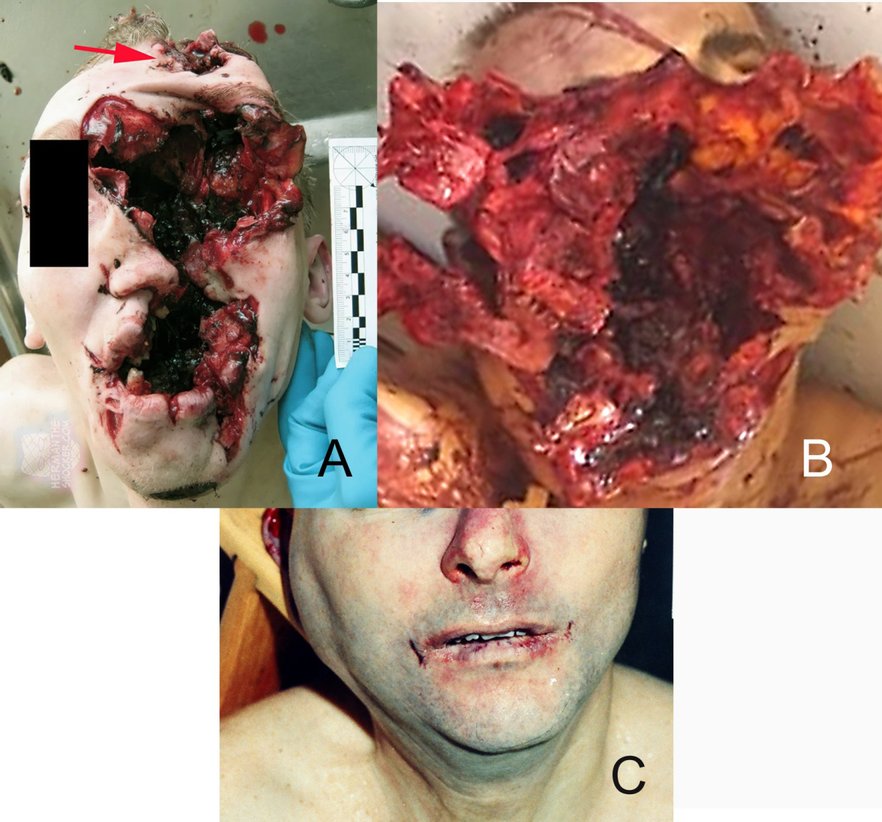Figure 20: Facial tearing due to intraoral firearm discharges. A. Suicide intraoral shotgun discharge showing massive facial damage; the shotgun stock was supported, which interfered with the recoil out of the victim’s mouth. The shotgun gauge was not divulged from the source. The exit wound, at the arrow, suggests the shotgun muzzle was on the superior hard palate at the barrel angle shown in Figures 5E&19 when it discharged, similar to Cobain’s entrance wound. Image from hermantheshocker. com/intraoral-suicide-with-a-shotgun/. B. Suicide victim by intraoral 12 gauge shotgun discharge causing massive facial tearing. Image from author FN. C. Homicide victim Colonel James Sabow; he showed minimal facial tearing after an intraoral 16-gauge shotgun discharge. The assailants attempted to stage a suicide after first striking him from behind with a club causing severe blunt force trauma to his occipital bone (posterior skull) followed by the intraoral 16-gauge shotgun discharge while he was lying on his side on the ground. The shotgun discharge angle was at approximately 65 degrees and was unsupported. Image from [25].