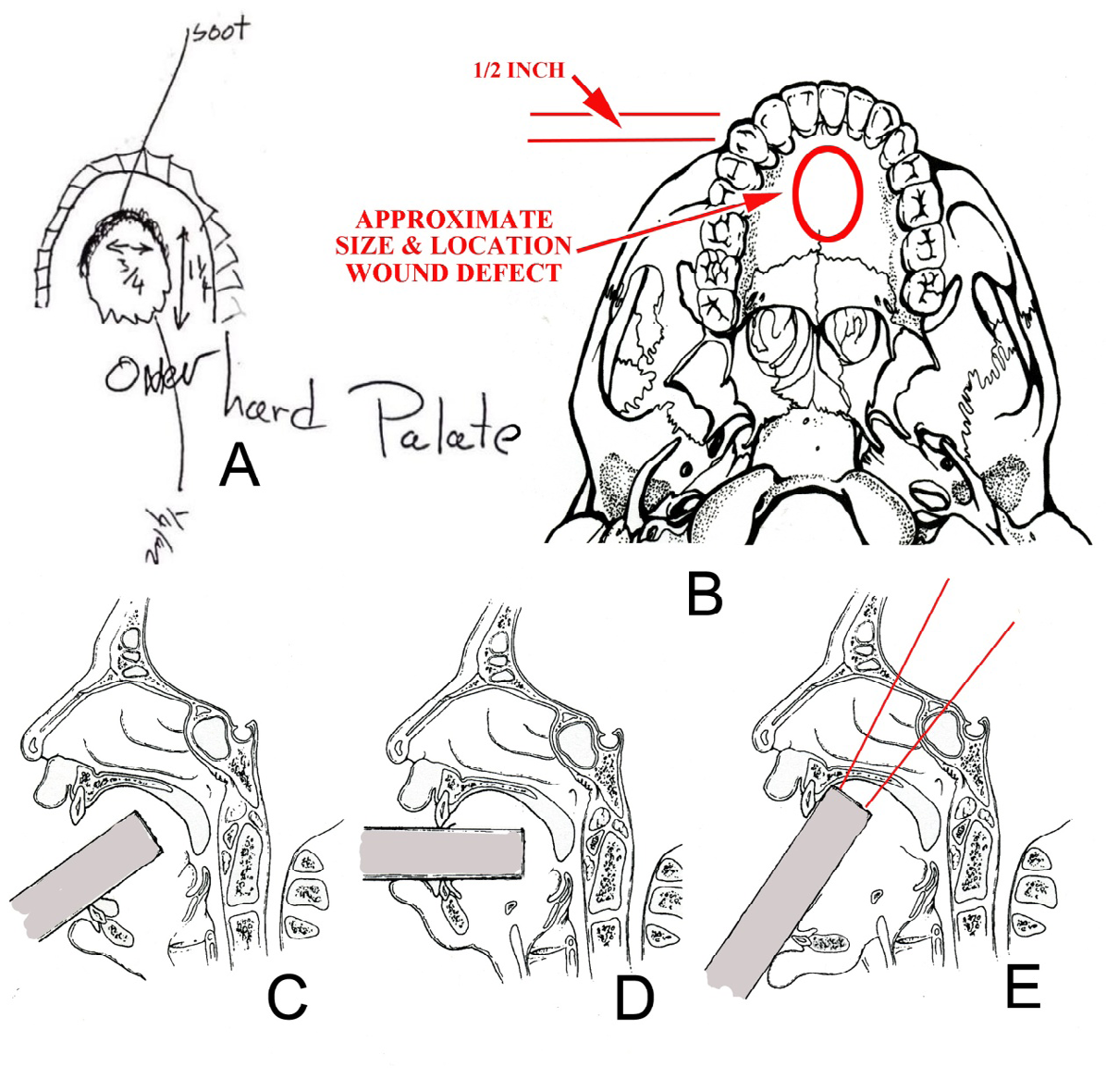 Figure 5: Wound and shotgun pellet path by the intraoral shotgun discharge. A. Rough sketch of the inferior view of the maxilla from the Cobain autopsy report of the entrance/exit wound on the superior hard palate [1]. B. Approximate size and location of the wound defect (red oval) in the hard palate in this inferior view of the skull without the mandible; the shotgun compensator muzzle was at contact or near contact and was at an angle to the hard palate at discharge. The autopsy report indicated that the superior portion of the defect had a distance of ½ inch (1.3 cm) from the back of the front maxillary teeth, which likely means that the shotgun compensator was against the upper rear of the teeth. Graphic by author BB. C. Illustration of a cross-section of the oral region showing the usual suicide position of the firearm barrel in the mouth of the victim; the entrance wound would be in the posterior hard palate/soft palate and about 60 degrees to the long axis of the body. From [22] with permission. D. Illustration of a cross-section of the oral region of the homicide position of a firearm barrel; in a typical homicide, the angle with the victim’s head is at 90 degrees and the entrance wound is in the posterior oral cavity. From [22] with permission. E. Illustration of a cross-section of the oral region of the position of the firearm muzzle or shotgun compensator/muzzle with the path (between the red lines) of the shotgun pellets based on the Cobain autopsy report [1]; the angle is approximately 35 degrees to the midline. Destruction and damage were to the bones at the base of the skull (frontal orbital bone) and the parietal and frontal lobes of the brain. The occipital lobes were partially destroyed [1]. Drawing modified from D by author BB.