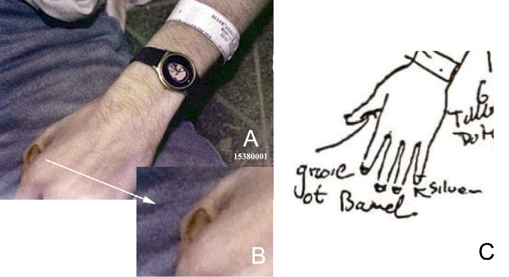 Figure 8: Cobain’s left hand. A. Enlargement of Fig. 1C showing Cobain’s left hand at the scene; the lack of backspatter on the dorsal surfaces of the hand indicates that his left hand was not holding the shotgun barrel near the mouth when it discharged. His long sleeve shirt likely had been pulled up to his upper arm by the SPD detectives when this image was taken. B. Higher magnification of this probable blood transfer; indicating the thumb came into contact with wet blood after a bleeding event, likely when it was applied to wet blood on the shotgun barrel. C. Drawing from the autopsy report showing the “groove of barrel” impression on the left thumb due to the early stage of putrefaction [1]. The transfer bloodstain outlines this defect.