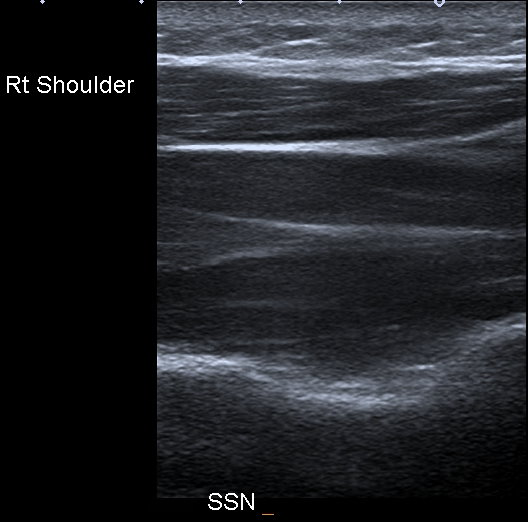 Figure 1: There is an accompanying artery which makes it easy to find with color Doppler. While injecting this region, patients often experience neural type pain radiating around the shoulder.