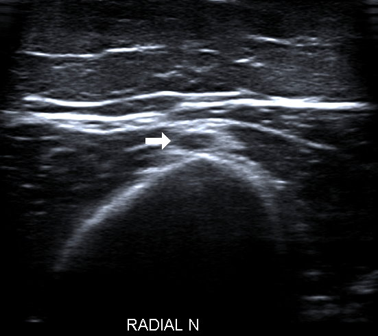 Figure 2: This is the easiest location to find it and inject it as it does not move away from the needle as it is pinned against the bone. It then moves medially and superficially as it progresses down past the elbow where it braches into posterior interosseos nerve (PIN) and superficial radial nerve. People who are used to locating it at this site to assess the PIN can find it here and then follow it back up the arm.