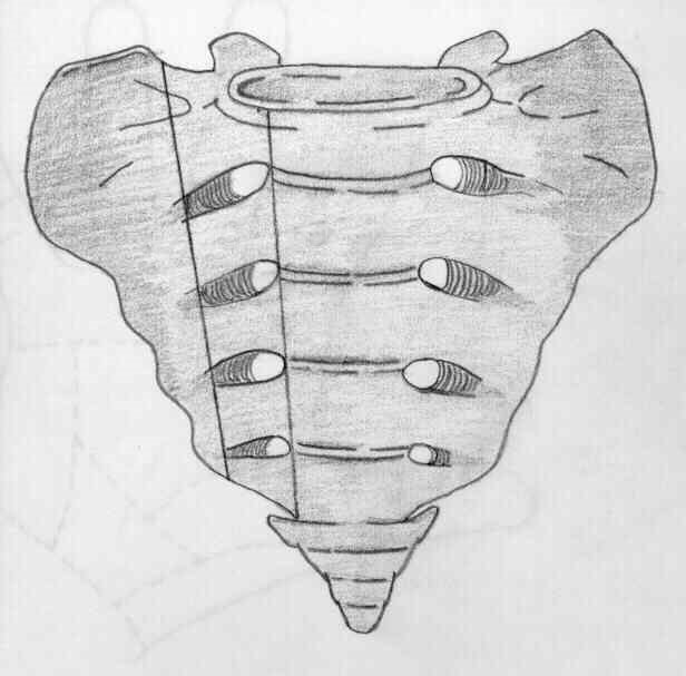Figure 3: The sizes are variable and sometimes very small. I approach the foramen from directly above to be able to insert the needle into the foramen, which is important to be able to block the deep nerve roots which are the target. If the block is done properly there will be complete anaesthesia of the patient’s buttock pain after it is done.