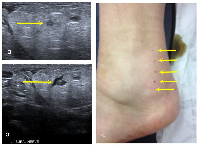 Figure 5: A sural nerve that was involved with a long segment compression by fibrous tissue. 5a shows the nerve before hydro- dissection and 5b shows the nerve after hydro-dissection. 5c shows the line of needle marks on the skin along the line of the nerve showing the multiple puncture marks used to dissect along its length.