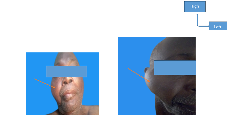 Figure 1: ** Tumoral mass deforming the right half of the face.