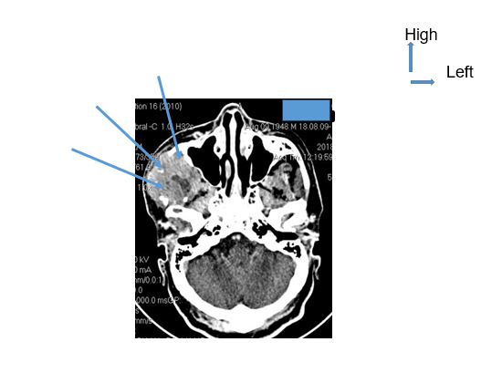 Figure 3: Computed tomography of the facial mass (axial section).