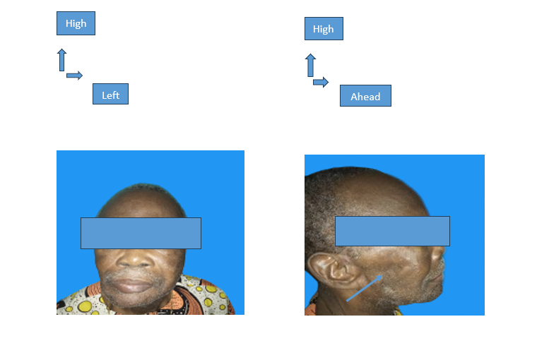 Figure 4: Result at 6 months post-operatively of a tumor mass with sequelae of excavation lesion on the right side on the profile image.