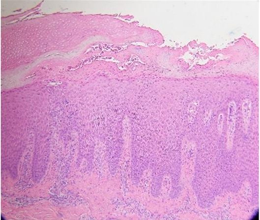 Figure 2: Histopathological findings showing elongation of rete ridges and parakeratosis.