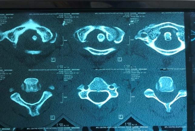 Figure 1: The CT scan revealed an atlantoaxial dislocation and geodic images of the C2 tooth.
