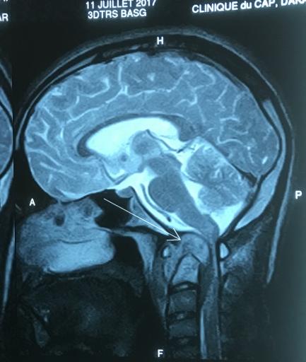 Figure 3: MRI control, show a regression of the collection and the mass effect of spinal cord