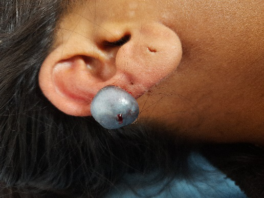 Figure 3: Large, dome-shaped keloid on the upper ear with visible surface discoloration and minor crusting.