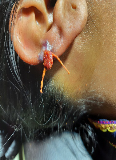 Figure 4: Pedunculated, reddish granulation-type growth extending from the lower ear near a piercing site.