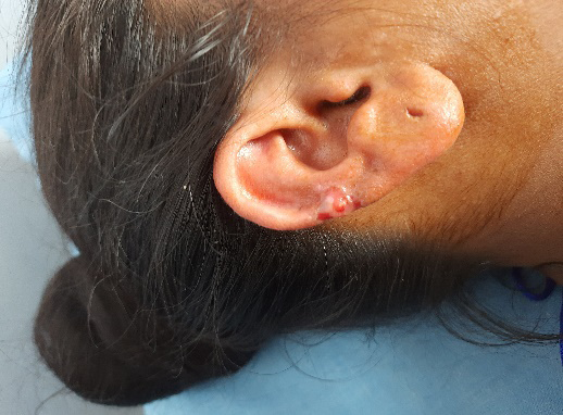 Figure 6: Healing post-excision site on the lower ear with mild redness near the previous piercing area.