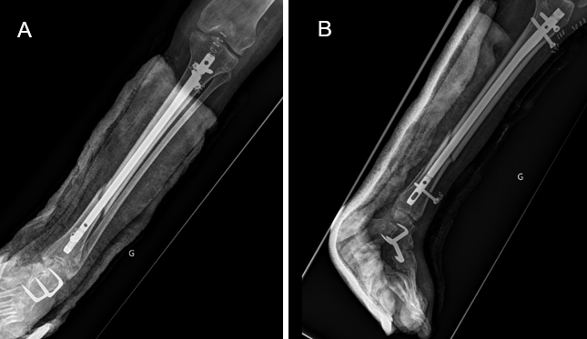 Figure 3: Immediate postoperative radiographic control (anteroposterior and lateral views).