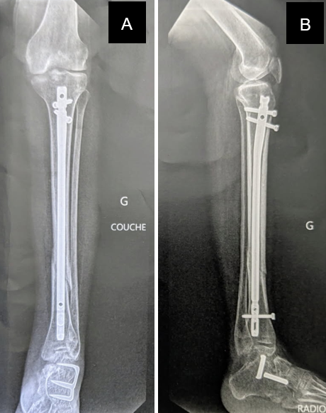 Figure 5: Four-month postoperative radiographic control, anteroposterior (A) and lateral (B) views.