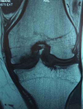 Figure 2: Aspect of the lesion on MRI.