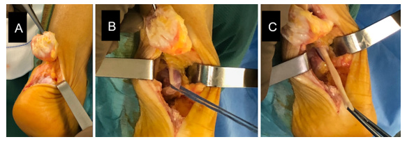 Figure 2: Detachment and elevation of the Achilles tendon followed by resection of the calcification (A), whipstitching of the FHL tendon (B), and distal transection with the foot in equinus (C).