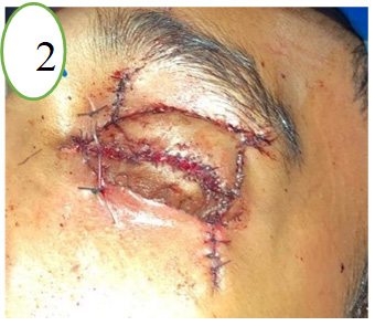 Figure 2: status of the immediate postoperative image of the reconstruction of the anterior lamella of both the upper and lower eyelids with full-thickness skin graft; the lacrimal drainage system is demarcated and fixated with silicone rod separately.