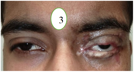 Figure 3: The patient’s eyelid condition status, with good aesthetic and functional outcomes after releasing the tarsorrhaphy. Still, ptosis is present, but it may be improved over time.