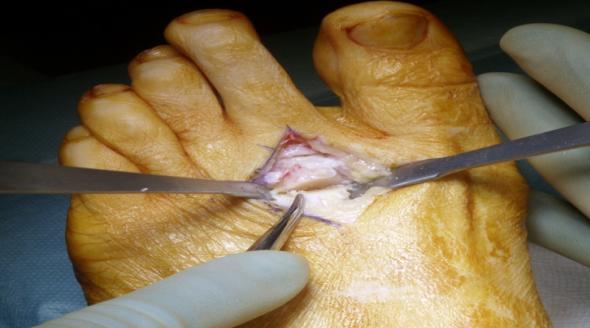 Figure 2: Fixation of osteotomy with Barouk headless compression screws.