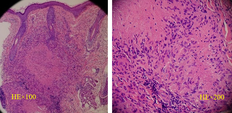 Figure 2: Pathological findings of Case 1. Amorphous substances are surrounded by epithelioid cells.