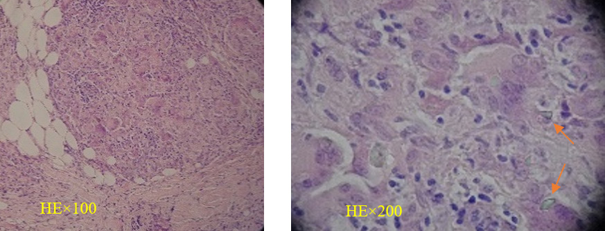 Figure 3: Pathological findings of Case 2. Epithelioid granuloma with multinucleated giant cells. Shiny foreign substances are found (arrows).