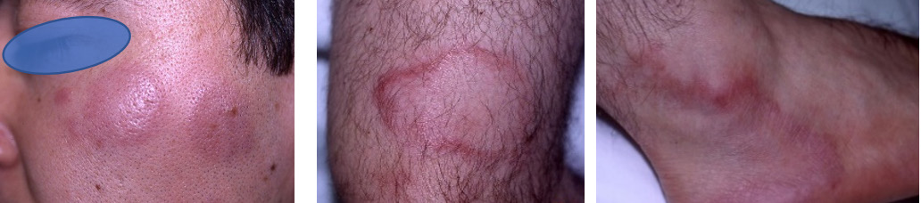 Figure 4: Clinical features of Case 3. Well-defined red plaques and annular lesions on patient’s face and extremities.