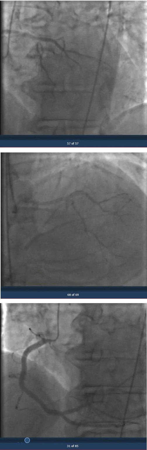 Figure 1: TTE showing Severe Aortic stenosis.