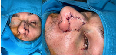Figure 3: Closure of the defect without tension, flap shows no signs of suffering.