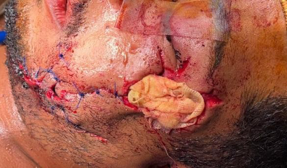 Figure 3: Postoperative appearance following angiocatheter-assisted parotid duct repair.