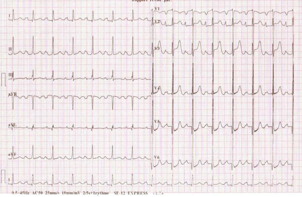 Figure 1: Electrocardiogram showing left atria hypertrophy and diastolic left ventricular hypertrophy.