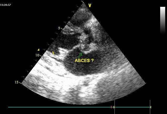 Figure 2: Transthoracic echocardiography image showing post-admission aortic abscess. The patient was put on probabilistic bi-antibiotic therapy (Gentamicin and Ceftriaxone) and under symptomatic treatment of heart failure (diuretics and ACE). Surgery indication was discussed The evolution under treatment was favorable with stable apyrexia, a regression of heart failure symptoms. However, systematic echocardiography and biology screening systematic before discharge, showed persistence of anemia, biological inflammatory syndrome, thrombocytopenia and image of abscess. Patient was discharged after 45 days of hospitalization and she was oriented in surgery. Four weeks later, the patient who did not receive surgical treatment was readmitted to the department for serious worsening of her condition. It is a state of septic shock associated with signs of global heart failure. The echocardiographic control noted a worsening of the abscess which doubled or tripled its volume (Figure 3).