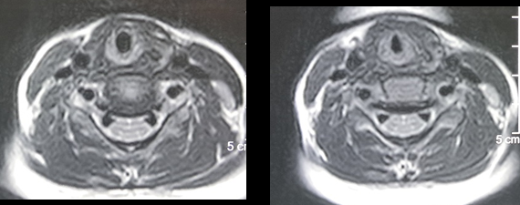 Figure 2: MRI suggestive of small T2 hyperintense focal signal in left upper lobe of thyroid gland with suspicious tract seen coursing superiorly to posterior pharyngeal wall, suspicious of 4th branchial cleft sinus anomaly.