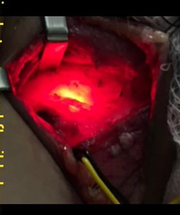 Figure 4: Transillumination of flexible fiberoptic scope in left pyriform fossa seen to identify the tract.