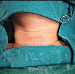 Figure 5: Clinical picture of neck with previous incision and drainage scar.