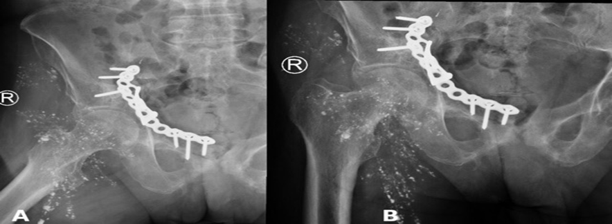 Figure 7: One-year follow-up radiographs. (A) Stable fixation with residual embolic material. (B) Maintained hardware position without implant failure.